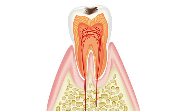 虫歯治療のイメージ
