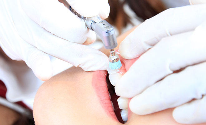 予防歯科治療イメージ